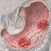 Bệnh Đau Dạ Dày Viêm trợt phù nề hang vị và cách điều trị mới