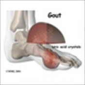 BỆNH GÚT-Bệnh GOUT VÀ thuốc chữa bệnh gút