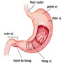 Viêm Dạ Dày Phù nề xung huyết Hang Vị và thuốc chữa