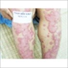 Chữa Bệnh Vẩy Nến Á Sừng bằng Kliquidclorophyll-A