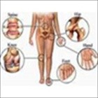 Bệnh Viêm Đa Khớp: Biểu hiện bệnh sinh và thuốc điều trị
